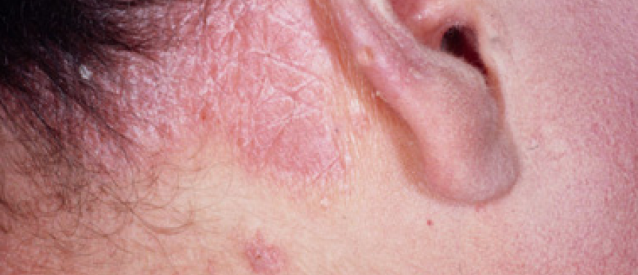 Le pétrole dans le traitement du psoriasis