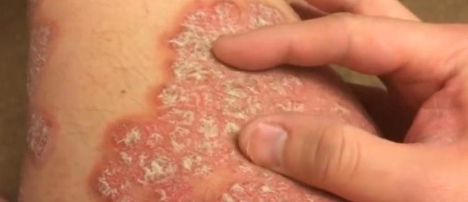 Lalimentation juste à leczéma sur les mains et les pieds