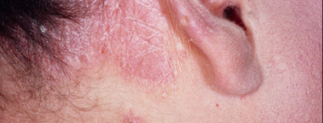 Les images selon le psoriasis