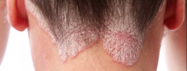 Les maladies des oeil leczéma du paupières