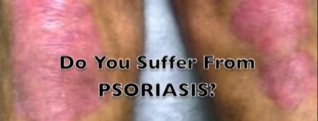 Le psoriasis chez lenfant dans 5 ans